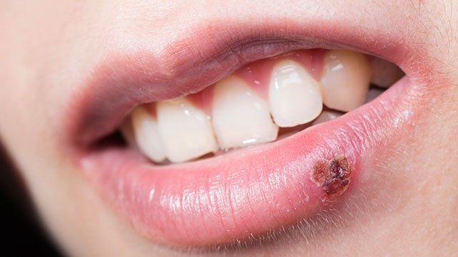What is herpes cold sores